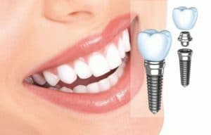 виды имплантации зубов