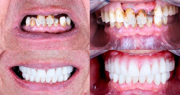 Протезирование при отсутствии всех зубов